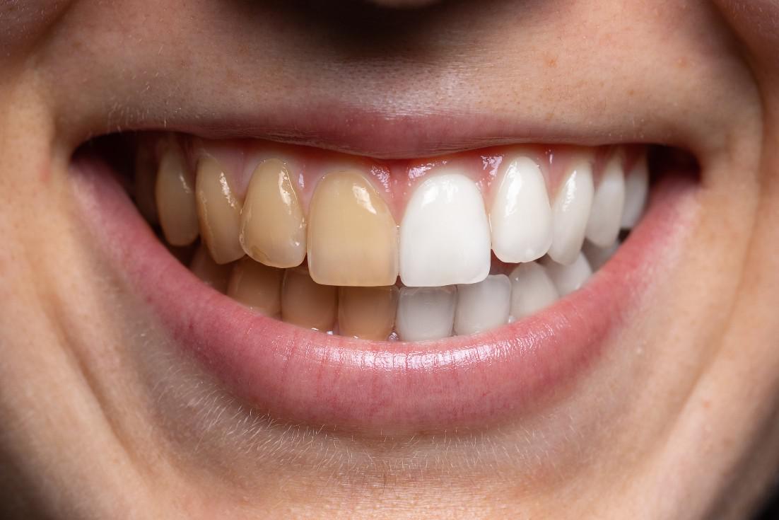 How to fix stained teeth